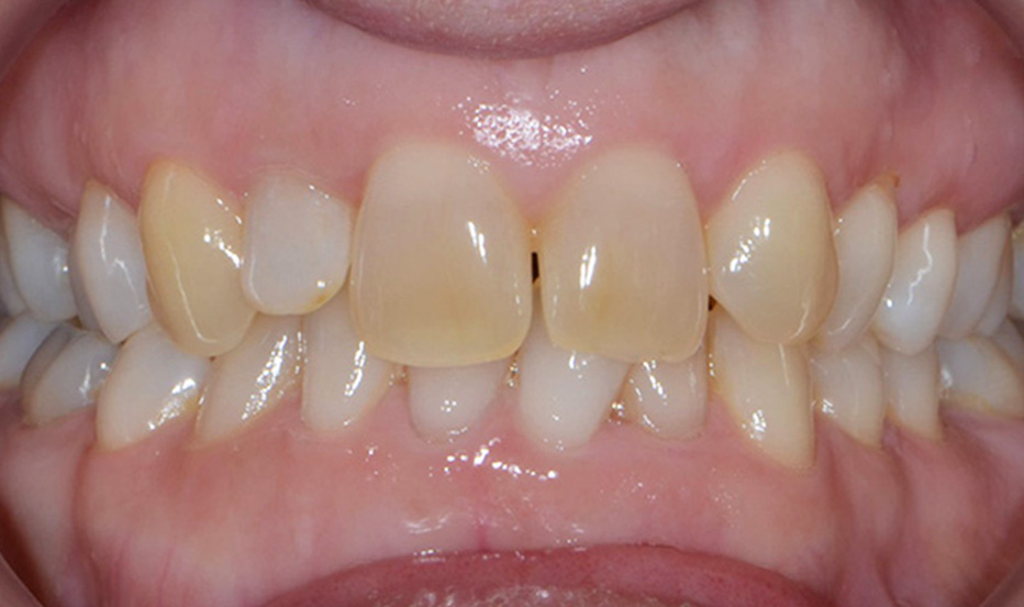 Före - Exempel 3: Tandhygienist - Smile Vänersborg