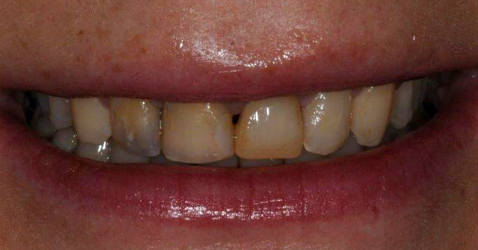 Efter - Missfärgade tänder